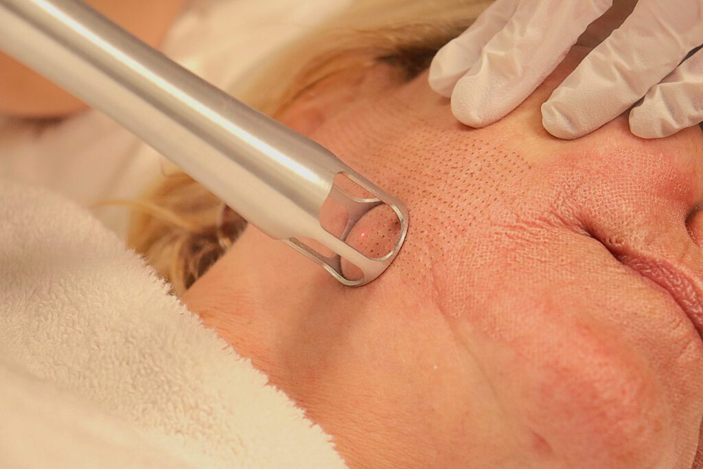 Laser-coring met de UltraClear